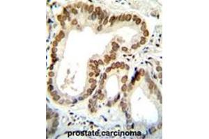 BTG2 Antibody (N-term) immunohistochemistry analysis in formalin fixed and paraffin embedded human prostate carcinoma followed by peroxidase conjugation of the secondary antibody and DAB staining. (BTG2 anticorps  (N-Term))