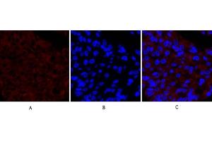 Immunofluorescence analysis of human liver cancer tissue. (PTGS2 anticorps  (AA 530-610))