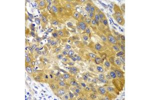 Immunohistochemistry of paraffin-embedded human esophageal cancer using  antibody (ABIN3021755, ABIN3021756, ABIN3021757 and ABIN6215776) at dilution of 1:100 (40x lens).