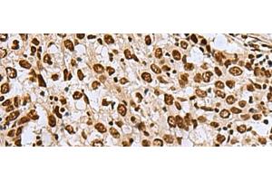 Immunohistochemistry of paraffin-embedded Human esophagus cancer tissue using MYEF2 Polyclonal Antibody at dilution of 1:70(x200) (MYEF2 anticorps)