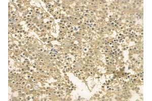 ABIN6262802 and ABIN6273129 at 1/100 staining human pituitary adenoma by IHC-P. (KIF12 anticorps  (N-Term))