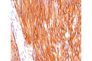 Formalin-paraffin human gastrointestinal stromal tumor (GIST) stained with CD117 antibody (C117/370). (KIT anticorps)