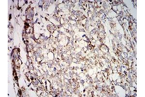 Immunohistochemical analysis of paraffin-embedded breast cancer tissues using SOD2 mouse mAb with DAB staining.