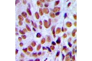 Immunohistochemical analysis of RUNX1 staining in human breast cancer formalin fixed paraffin embedded tissue section. (RUNX1 anticorps)