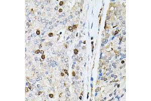 Immunohistochemistry of paraffin-embedded human prostate cancer using PNKP antibody. (PNKP anticorps  (AA 60-320))