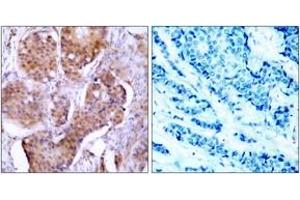 Immunohistochemistry analysis of paraffin-embedded human breast carcinoma, using Estrogen Receptor-alpha (Phospho-Ser106) Antibody. (Estrogen Receptor alpha anticorps  (pSer106))
