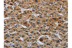 The image on the left is immunohistochemistry of paraffin-embedded Human liver cancer tissue using ABIN7191086(IL31 Antibody) at dilution 1/20, on the right is treated with synthetic peptide. (IL-31 anticorps)