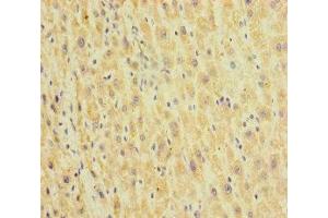 Immunohistochemistry of paraffin-embedded human liver cancer using ABIN7155002 at dilution of 1:100