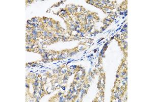 Immunohistochemistry of paraffin-embedded human gastric cancer using EPB41 antibody (ABIN1872554) at dilution of 1:100 (40x lens). (EPB41 anticorps)