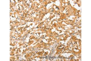 Immunohistochemistry of Human liver cancer using APTX Polyclonal Antibody at dilution of 1:50 (Aprataxin anticorps)