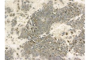 ABIN6263876 and ABIN6272759 at 1/100 staining human melanoma by IHC-P.
