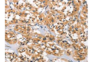 The image on the left is immunohistochemistry of paraffin-embedded Human thyroid cancer tissue using ABIN7129208(DKK3 Antibody) at dilution 1/30, on the right is treated with fusion protein.