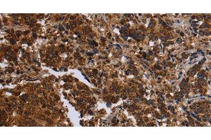 Immunohistochemistry of paraffin-embedded Human liver cancer tissue using FMN2 Polyclonal Antibody at dilution 1:30 (Formin 2 anticorps)