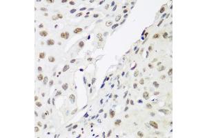Immunohistochemistry of paraffin-embedded human lung cancer using CBX3 antibody. (CBX3 anticorps)