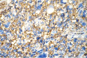 Immunohistochemistry was performed on paraffin-embedded human glioblastoma using leucine aminopeptidase 3 antibody (ABIN7798268), 1:200).