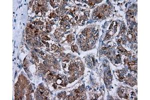 Immunohistochemical staining of paraffin-embedded Carcinoma of prostate tissue using anti-RC201933 mouse monoclonal antibody. (PIM2 anticorps)