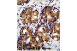 HR Antibody (C-term) (ABIN655716 and ABIN2845166) iunohistochemistry analysis in formalin fixed and paraffin embedded human breast carcinoma followed by peroxidase conjugation of the secondary antibody and DAB staining.