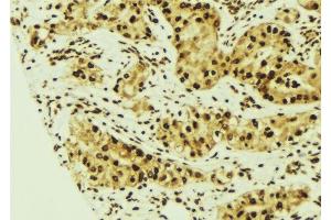 ABIN6275527 at 1/100 staining Human breast cancer tissue by IHC-P.