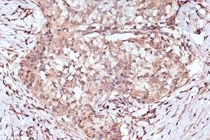 Immunohistochemistry of paraffin-embedded human esophageal cancer using B Rabbit mAb (ABIN7265849) at dilution of 1:100 (40x lens).