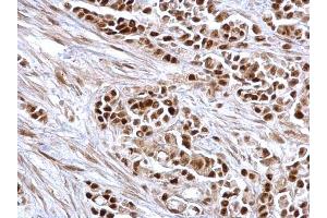 IHC-P Image Rb antibody detects Rb protein at nucleus on human colon carcinoma by immunohistochemical analysis. (Retinoblastoma 1 anticorps  (C-Term))