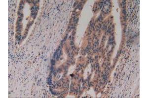 IHC-P analysis of Human Rectum Cancer Tissue, with DAB staining. (Caspase 8 anticorps  (AA 7-216))