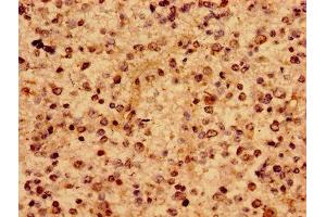 Immunohistochemistry of paraffin-embedded human glioma using ABIN7167217 at dilution of 1:100