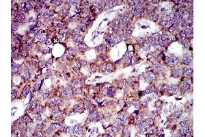 Immunohistochemical analysis of paraffin-embedded esophageal cancer tissues using MRPL42 mouse mAb with DAB staining. (MRPL42 anticorps  (AA 10-142))