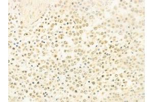ABIN6263496 and ABIN6278768 at 1/100 staining human Hodgkin lymphoma by IHC-P.