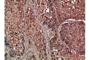 Immunohistochemical analysis of paraffin-embedded human-lung-cancer, antibody was diluted at 1:200