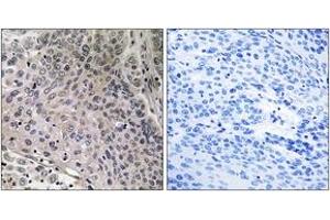 Immunohistochemistry analysis of paraffin-embedded human breast carcinoma tissue, using TEBP (Ab-113) Antibody.