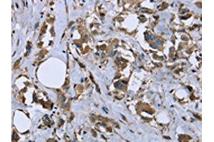 The image on the left is immunohistochemistry of paraffin-embedded Human breast cancer tissue using ABIN7130317(MYL12B Antibody) at dilution 1/20, on the right is treated with fusion protein. (MYL12B anticorps)