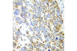 Immunohistochemistry of paraffin-embedded human esophageal cancer using CHIA antibody. (CHIA anticorps  (AA 1-368))