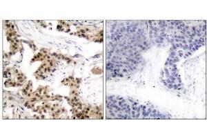 Immunohistochemical analysis of paraffin-embedded human breast carcinoma tissue using NF-κB p105/p50 (phospho-Ser893) antibody (E011018). (NFKB1 anticorps  (pSer893))