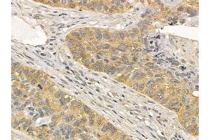 EPHB4 Mouse Monoclonal Antibody at 1/100 staining human lung cancer and adjacent non-tumor tissue by IHC-P. (EPH Receptor B4 anticorps  (Internal Region))
