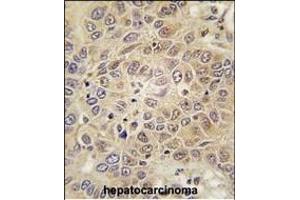 Forlin-fixed and paraffin-embedded hun hepatocarcino tissue reacted with RS antibody (C-term) (ABIN392313 and ABIN2841964) , which was peroxidase-conjugated to the secondary antibody, followed by DAB staining.