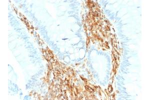Formalin-fixed, paraffin-embedded human Colon Carcinoma stained with Vimentin Rabbit Recombinant Monoclonal Antibody (VIM/1937R). (Recombinant Vimentin anticorps)