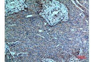 Immunohistochemistry (IHC) analysis of paraffin-embedded Human Breast Cancer, antibody was diluted at 1:100.