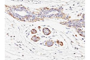 Formalin-fixed, paraffin-embedded human Breast Carcinoma stained with SM-MHC Mouse Monoclonal Antibody (MYH11/923).