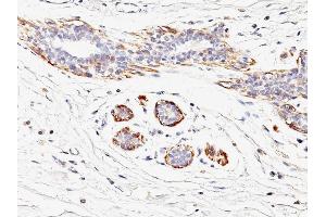Formalin-fixed, paraffin-embedded human Breast Carcinoma stained with SM-MHC Mouse Monoclonal Antibody (MYH11/923). (MYH11 anticorps)