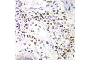 Immunohistochemistry of paraffin-embedded human colon using SMARCA4 antibody (ABIN6290438) at dilution of 1:100 (40x lens). (SMARCA4 anticorps)