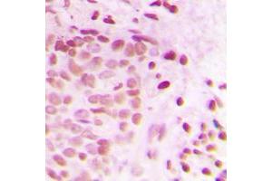 Immunohistochemical analysis of ATRIP staining in human breast cancer formalin fixed paraffin embedded tissue section.