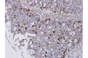 IHC-P Image Immunohistochemical analysis of paraffin-embedded human ovarian cancer, using FOXM1, antibody at 1:100 dilution. (FOXM1 anticorps  (C-Term))