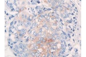 Detection of FBN1 in Human Breast cancer Tissue using Polyclonal Antibody to Fibrillin 1 (FBN1)