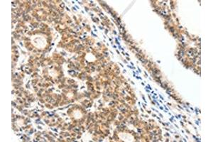 The image on the left is immunohistochemistry of paraffin-embedded Human thyroid cancer tissue using ABIN7192279(SCN2A Antibody) at dilution 1/25, on the right is treated with synthetic peptide. (SCN2A anticorps)