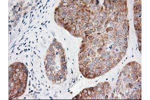 Immunohistochemical staining of paraffin-embedded Adenocarcinoma of Human breast tissue using anti-LCMT1 mouse monoclonal antibody.