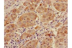 Immunohistochemistry of paraffin-embedded human liver cancer using ABIN7143645 at dilution of 1:100