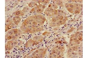 Immunohistochemistry of paraffin-embedded human liver cancer using ABIN7143645 at dilution of 1:100 (ADH1B anticorps  (AA 2-375))
