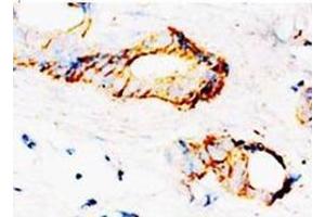Immunohistochemical analysis of paraffin-embedded mammary cancer sections, staining SAMDC in cytoplasm, DAB Chromogenic reaction