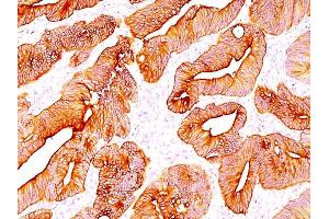 Formalin-fixed, paraffin-embedded human Colon Carcinoma stained with Multi Cytokeratin Mouse Monoclonal Antibody (C11). (KRT4, KRT5, KRT6, KRT8, KRT10, KRT13, KRT18 anticorps)