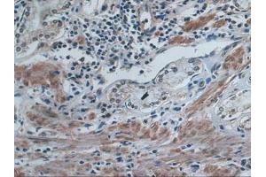 IHC-P analysis of Human Stomach Cancer Tissue, with DAB staining. (IDE anticorps  (AA 753-973))